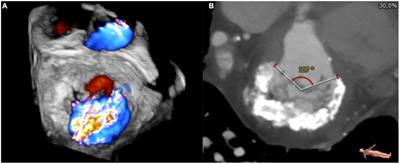 Mitral annular calcification in patients with significant mitral valve disease: An old problem with new solutions